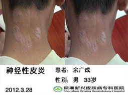 新兴医院皮炎治疗视频